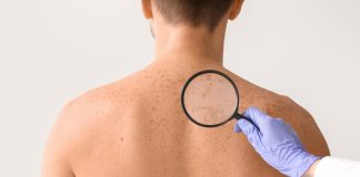 Descopera cele 10 mituri false despre aparitia petelor pe piele